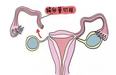 浙江慈铭博鳌国际医院三代试管婴儿，切除双侧输卵管还能做试管婴儿吗？